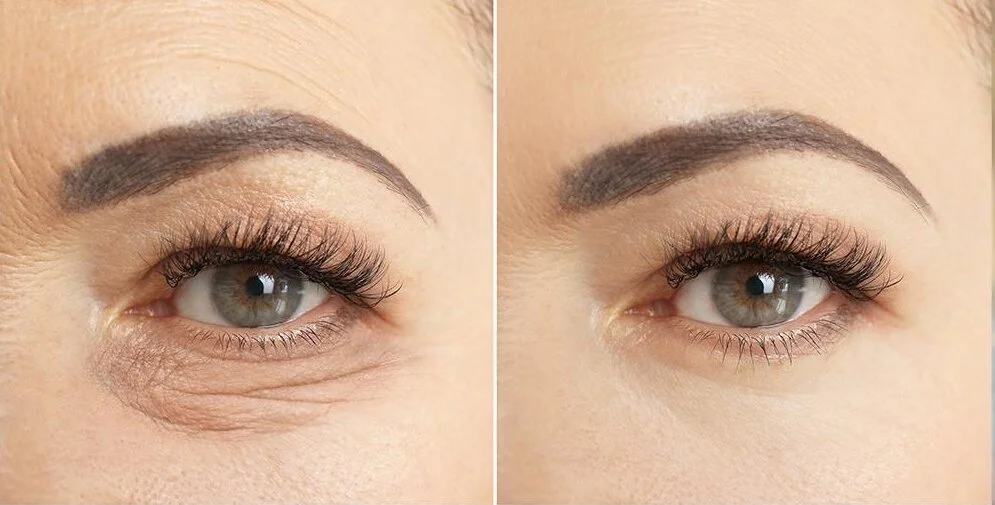 Augenlidkorrektur Merhabeauty