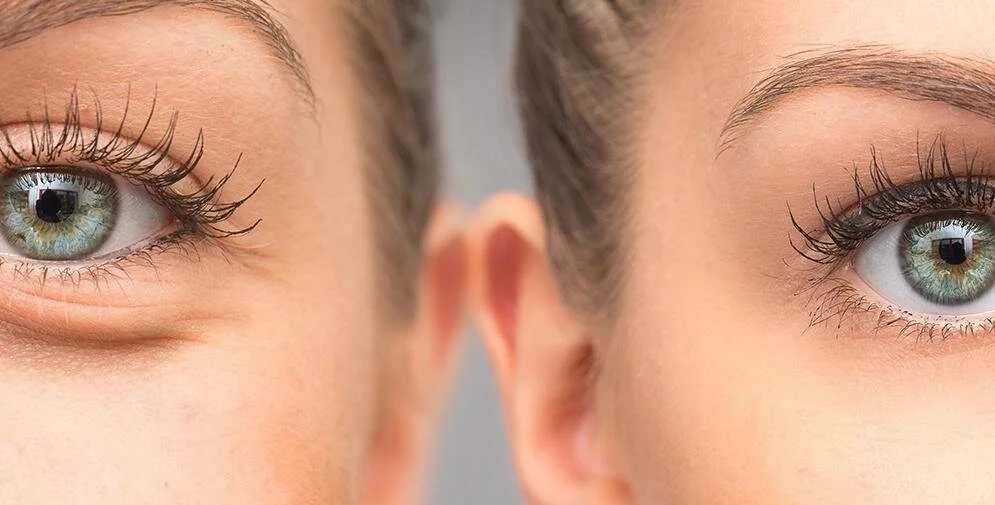 Augenlidstraffung MerhaBeauty