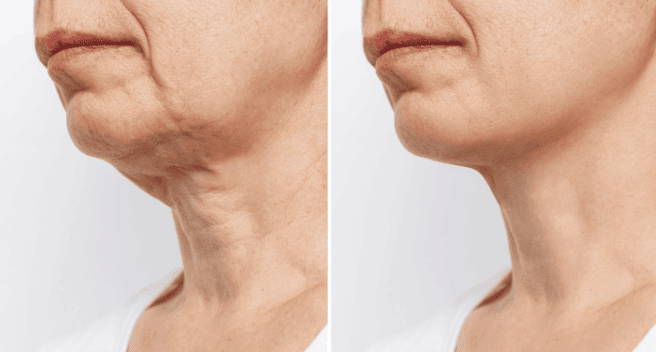 Facelifting bei MerhaBeauty in der Türkei