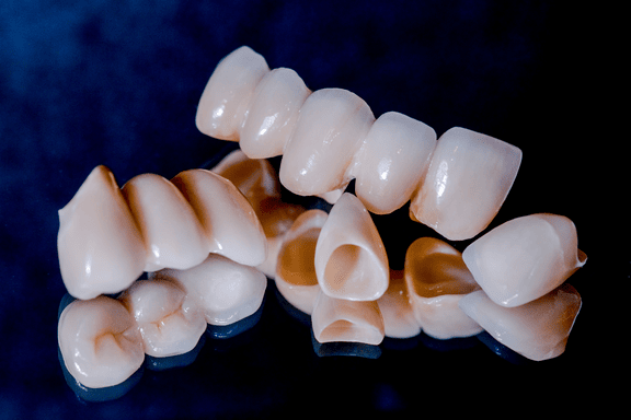 Zahnbrücke MerhaBeauty