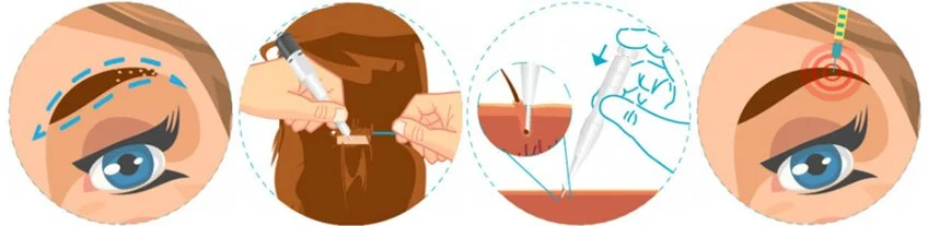 Augenbrauentransplantation 1 Antalya Merhabeauty 
