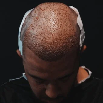 Haartransplantation MerhaBeauty