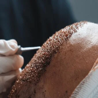 Haartransplantation MerhaBeauty