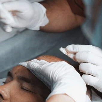 Haartransplantation MerhaBeauty