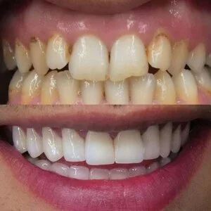 All on 4 MerhabBeauty vorher - nachher 1