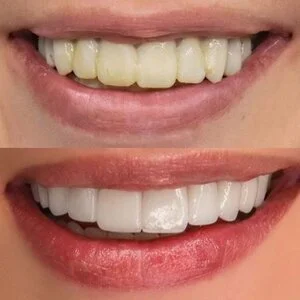 All on 4 MerhabBeauty vorher - nachher 5