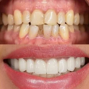 All on 4 MerhabBeauty vorher - nachher 6