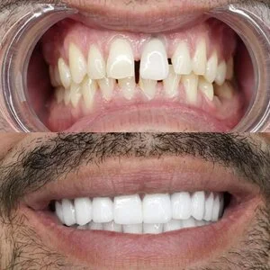 All on 4 MerhabBeauty vorher - nachher 7