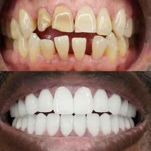 All on 4 MerhabBeauty vorher - nachher 8