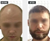 Haartransplantation Vorher-Nachher MerhaBeauty