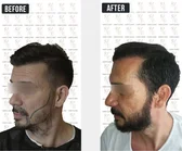 Haartransplantation Vorher-Nachher MerhaBeauty