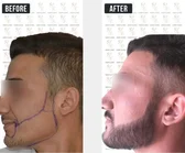 Haartransplantation Vorher-Nachher MerhaBeauty