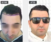 Haartransplantation Vorher-Nachher MerhaBeauty