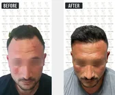 Haartransplantation Vorher-Nachher MerhaBeauty