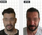 Haartransplantation Vorher-Nachher MerhaBeauty