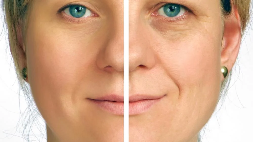 Facelifting bei MerhaBeauty in der Türkei