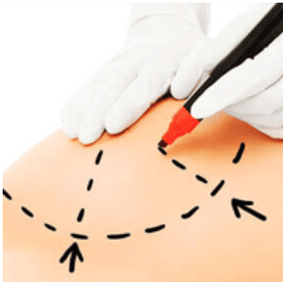 Brustverkleinerung Türkei/ Antalya- Merhabeauty