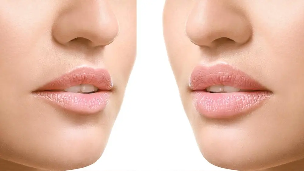 Lippenlifting in der Türkei bei Merhabeauty