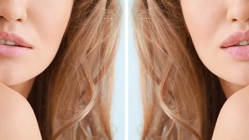 Lippenlifting in der Türkei bei Merhabeauty