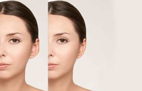 Ohrenkorrektur MerhaBeauty