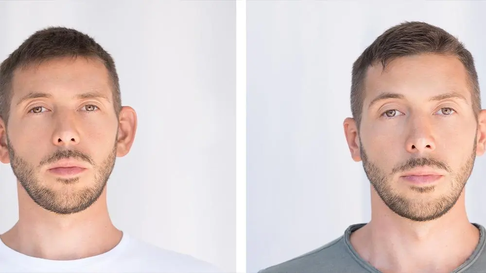 Ohrenkorrektur bei Merhabeauty Ohrenkorrektur bei Merhabeauty