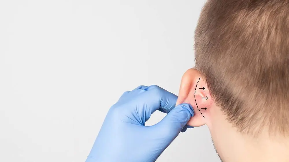 Ohrenkorrektur bei Merhabeauty Ohrenkorrektur bei Merhabeauty