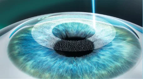 Relex Smile Merhabeauty