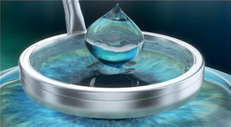 Relex Smile Merhabeauty