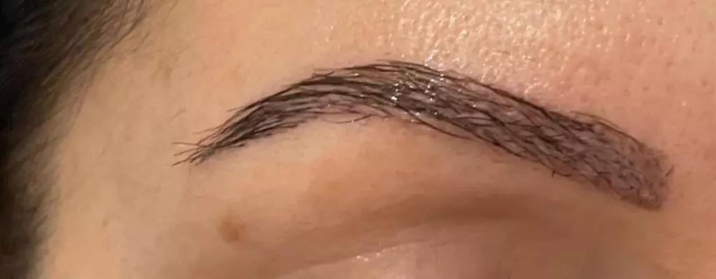 Augenbrauentransplantation vorher nachher MerhaBeauty 9
